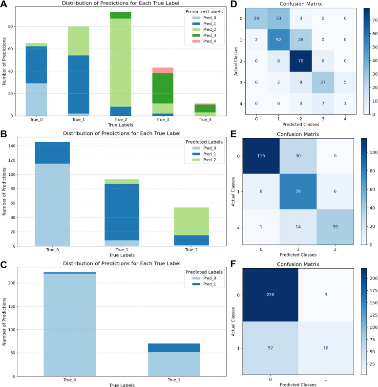 Foundation models in ophthalmology: a preliminary study on AI-assisted diagnosis of myopic maculopathy and posterior staphyloma using ultra-widefield fundus images.