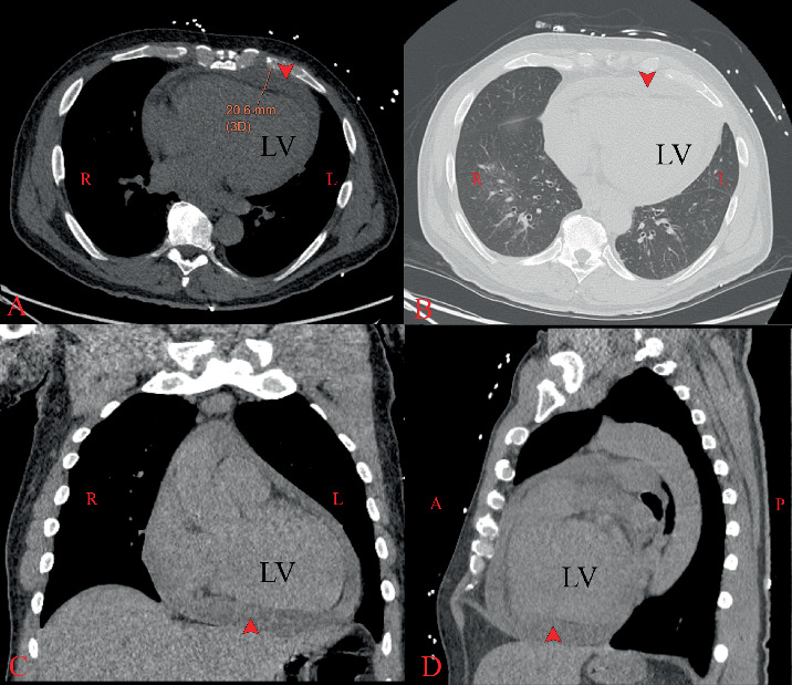 Pneumococcal Pyopericardium With Xiphoid Osteomyelitis in HIV/AIDS: A Rare but Potentially Fatal Complication.