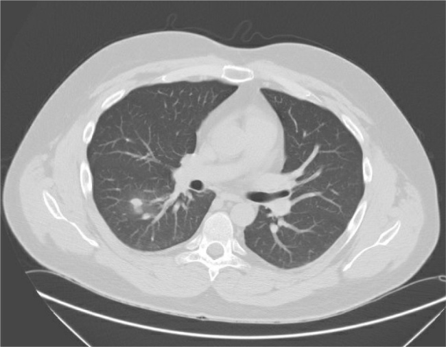 A Silent Invader: Asymptomatic Rhodococcus Infection Unmasked in A Patient with Ectopic ACTH-Dependent Cushing's Syndrome.