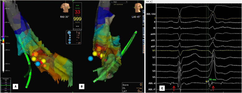 Delayed recurrence of complete atrioventricular block following ablation for premature ventricular complexes.