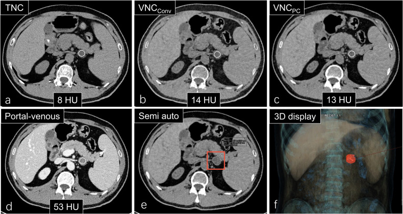 Virtual noncontrast images of adrenal lesions: a photon-counting CT prospective study.