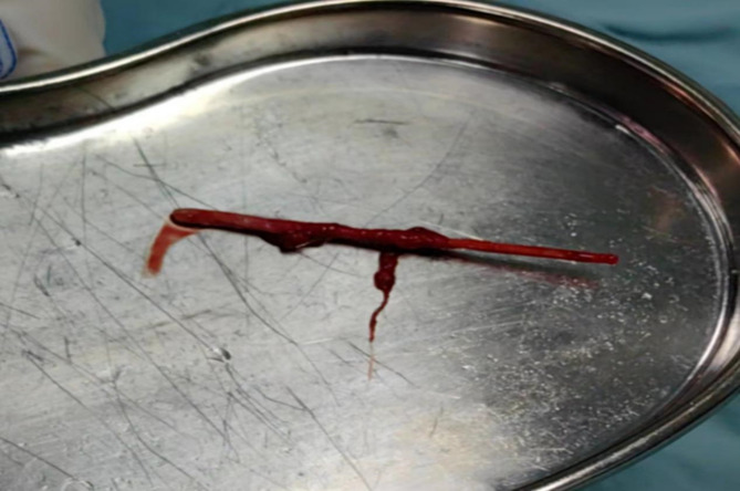 Migration of a urethral foreign body into the scrotum in an adolescent: a case report.