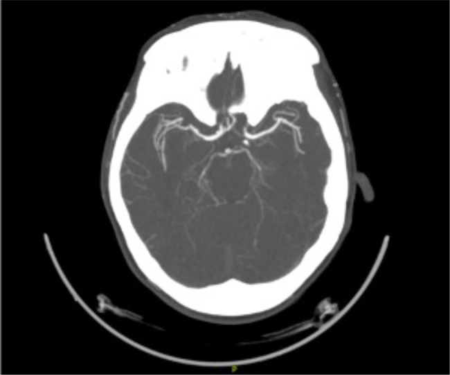 Rapidly Progressive Primary Central Nervous System Vasculitis: A Rare Case with Multifocal Small and Medium Vessel Involvement.