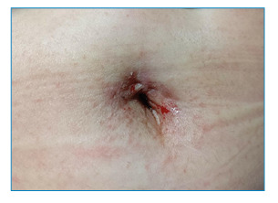 Umbilical Scabies.