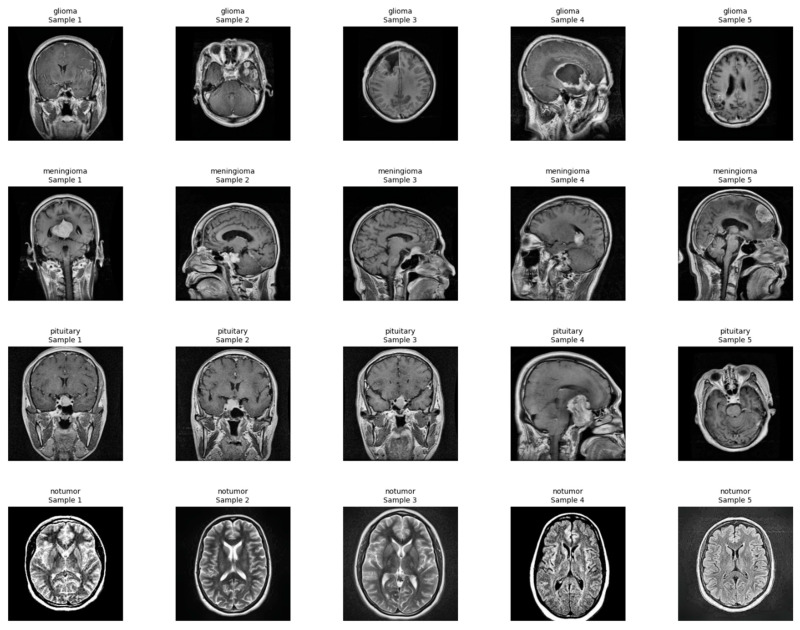 A Web-Deployed, Explainable AI System for Comprehensive Brain Tumor Diagnosis.