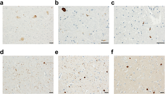 Evidence of a novel α-synuclein strain isolated from a Parkinson's disease with dementia patient sample.