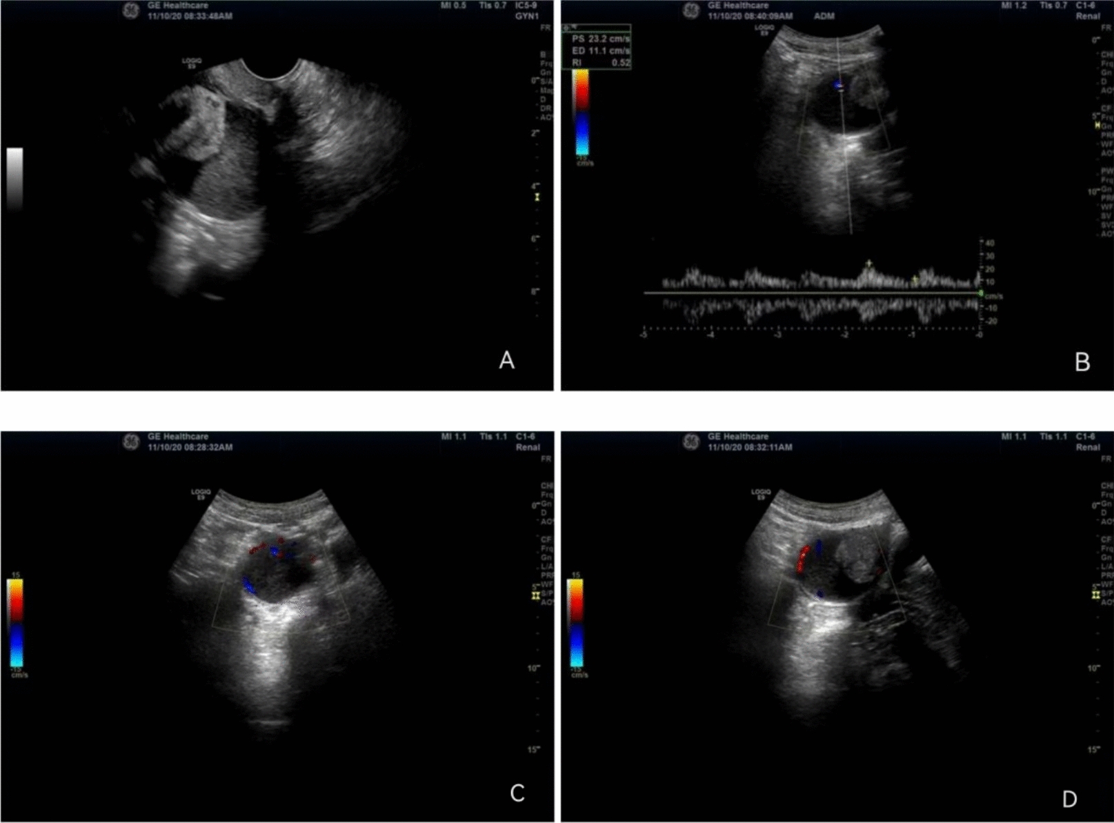 Sarcomatoid transformation of uterine myoma identified through physical examination: a case report.