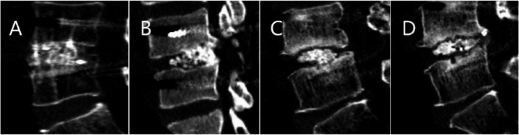 Comparative study of modified midline lumbar interbody fusion and modified transforaminal lumbar interbody fusion for the treatment of single-level lumbar degenerative diseases.