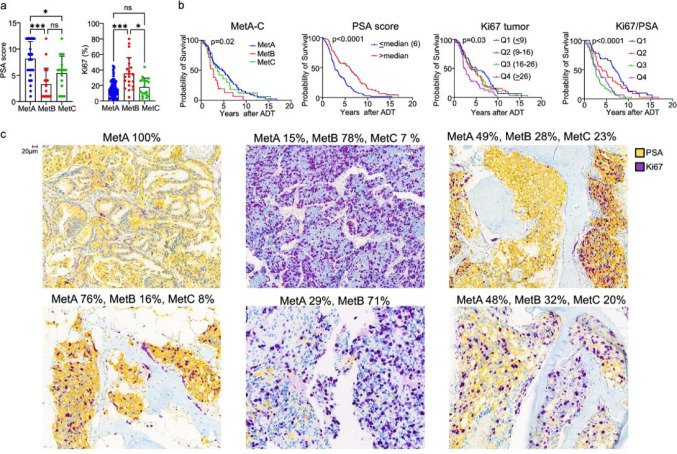 Morphological heterogeneities in prostate cancer bone metastases are related to molecular subtypes and prognosis.