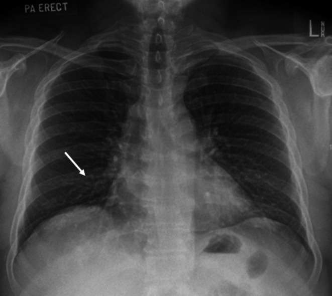 Airway Foreign Body-Leave Nothing Behind.