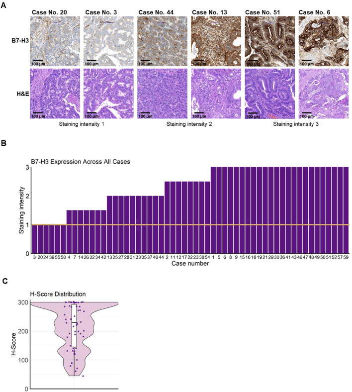 B7-H3: a consistent marker in metastatic colorectal cancer with potential for targeted treatment.
