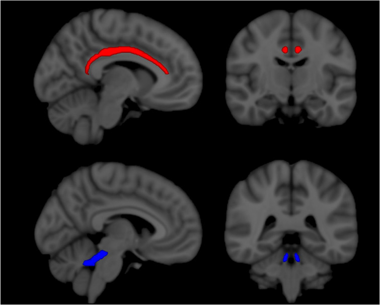 Diffusion tensor imaging in the SPRINT-MS clinical trial: Advancing trial methodology.