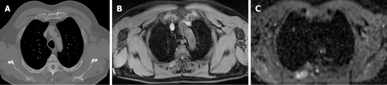 Whole-body magnetic resonance imaging for cutaneous melanoma staging: A scientific review.