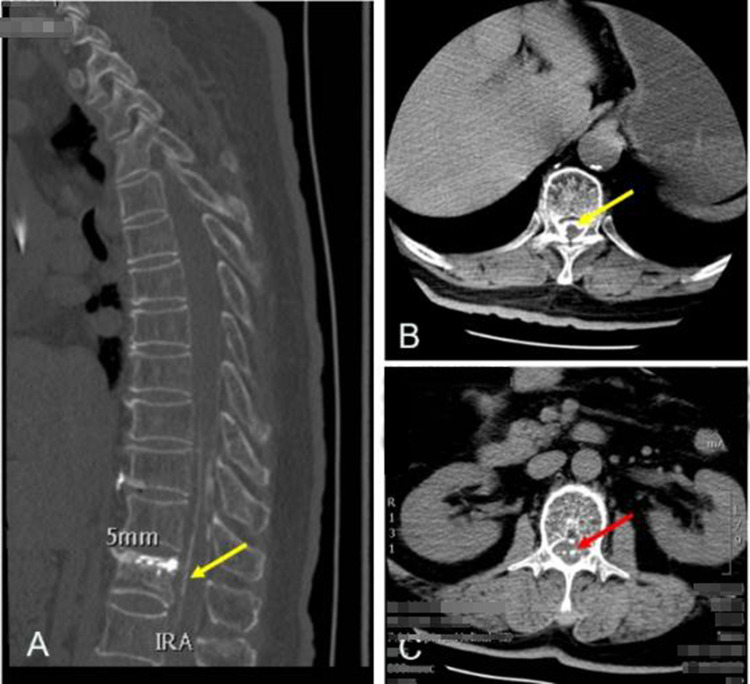 Percutaneous Vertebroplasty Using GeneX<sup>®</sup> in Osteoporotic Vertebral Compression Fractures: A Case Report.