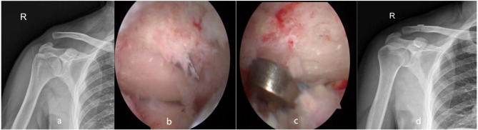 Clinical and Radiological Assessment of Modified Weaver-Dunn Technology, Arthroscopic Single Tunnel Technique and Arthroscopic Coracoid Sling Technique Three Different Surgical Techniques in the Treatment of Acute Rockwood III-V Acromioclavicular Dislocations.