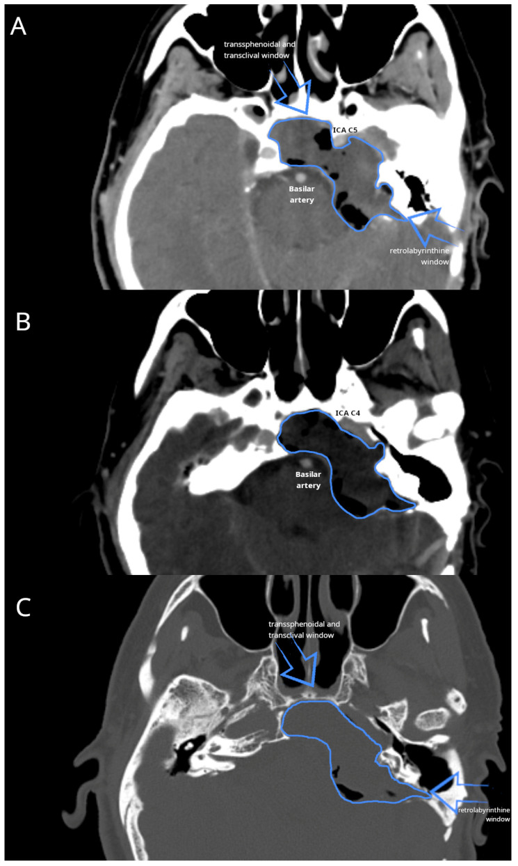 Extensive Cholesteatoma Compromising the Entire Ipsilateral Skull Base: Excision Through a Multi-Corridor Surgical Technique.