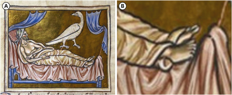 A Medical Error of Saints Cosmas and Damian: Reflections on Fallibility and Medical Education From a Medieval Miracle.