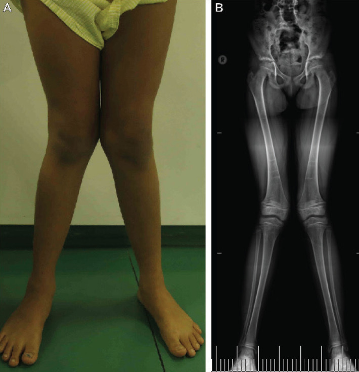 Novel Variant of <i>SLC34A3</i> in a Compound Heterozygous Brazilian Girl with Hereditary Hypophosphatemic Rickets with Hypercalciuria
