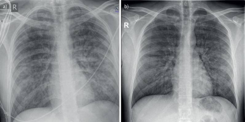 Acute post-operative respiratory insufficiency and diffuse alveolar haemorrhage in a young and healthy adult.