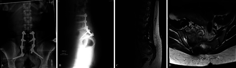 S3 sacral-alar iliac screws application in partial sacral resection for an aneurysmal bone cyst: illustrative case.