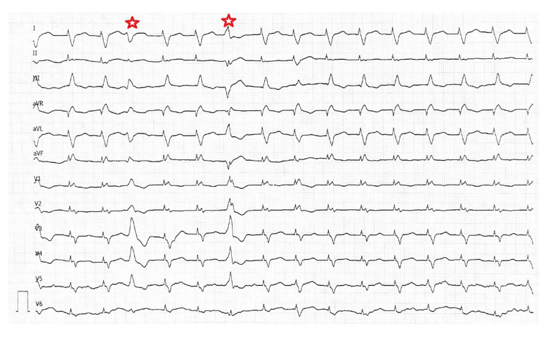 Crucial Role of Early Detection in Managing Heart Failure in Kearns-Sayre Syndrome: A Case Report.