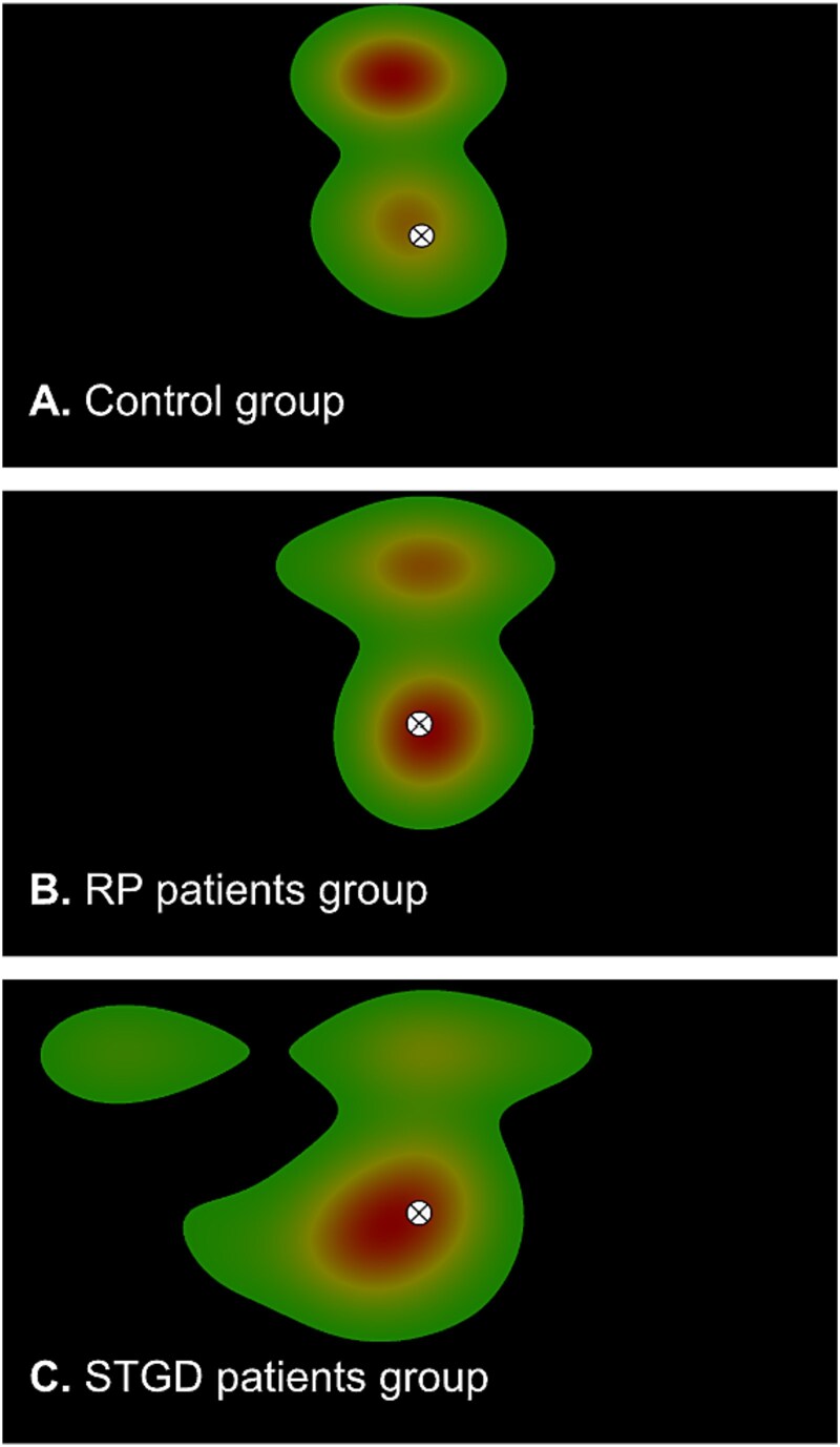 Cortical response to transient and long-term visual field loss.