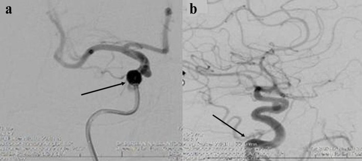A Successful Treatment of Hemifacial Spasm After Flow Diverter Stent Placement for Ipsilateral Internal Carotid Artery Saccular Aneurysm.