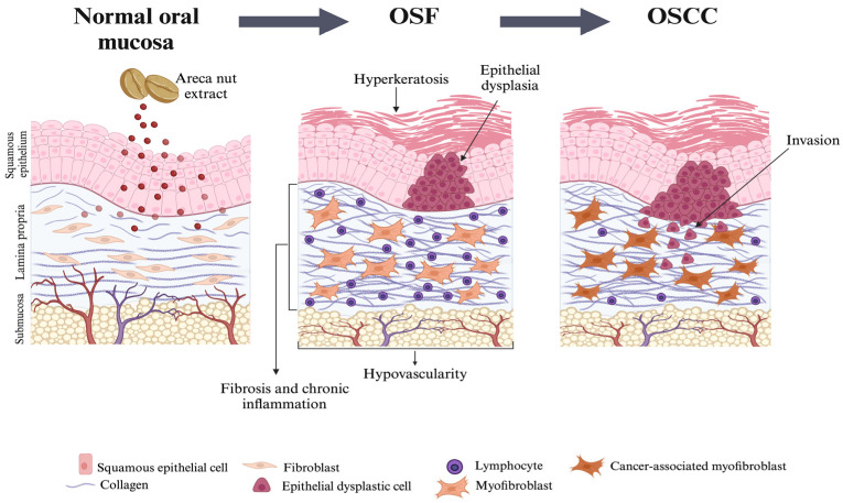 The Areca Nut and Oral Submucosal Fibrosis: A Narrative Review.