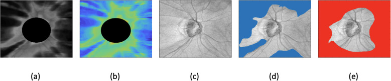 Glaucoma detection in myopic eyes using deep learning autoencoder-based regions of interest.