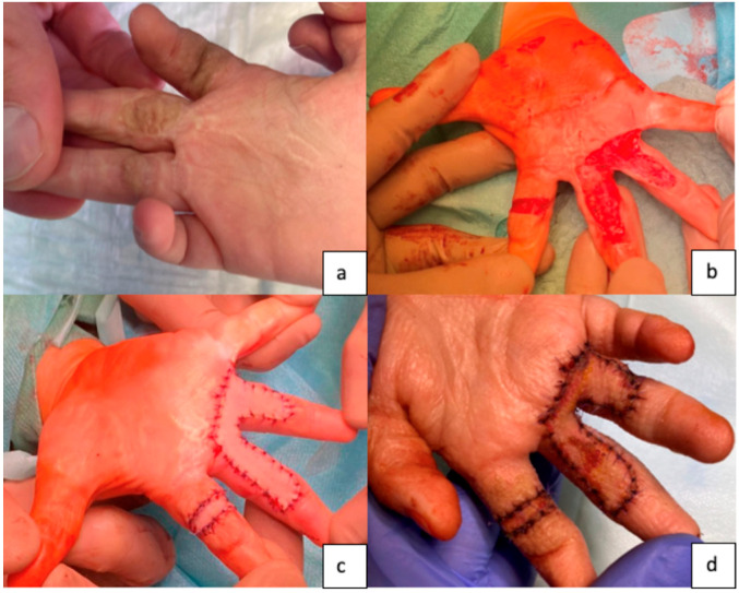 Development of a Device for Defatting Full Skin Grafts Through Mechanical Defatting in Children and Adolescents.