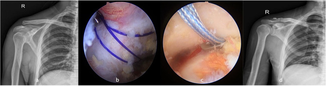 Clinical and Radiological Assessment of Modified Weaver-Dunn Technology, Arthroscopic Single Tunnel Technique and Arthroscopic Coracoid Sling Technique Three Different Surgical Techniques in the Treatment of Acute Rockwood III-V Acromioclavicular Dislocations.