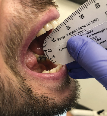 Suspected Posttraumatic Mandibular Coronoid Hyperplasia and Condylar Hypoplasia: Two Case Reports and Literature Review.