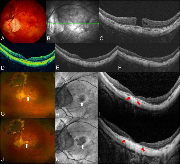 Long-term surgical outcome of high myopic full-thickness macular hole without retinoschisis.