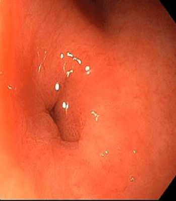Gastrointestinal Fistulas-What Gastroenterologists Need to Know in 2025.