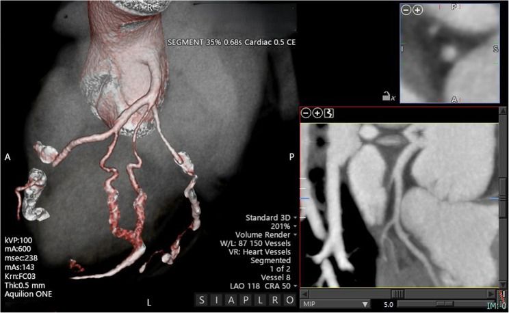 Multimodal imaging in young male with bicuspid aortic valve, right-sided aorto-atrial fistula and single coronary artery.