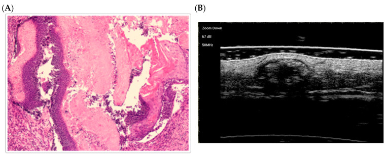 Pilomatricoma in Syndromic Contexts: A Literature Review and a Report of a Case in Apert Syndrome.
