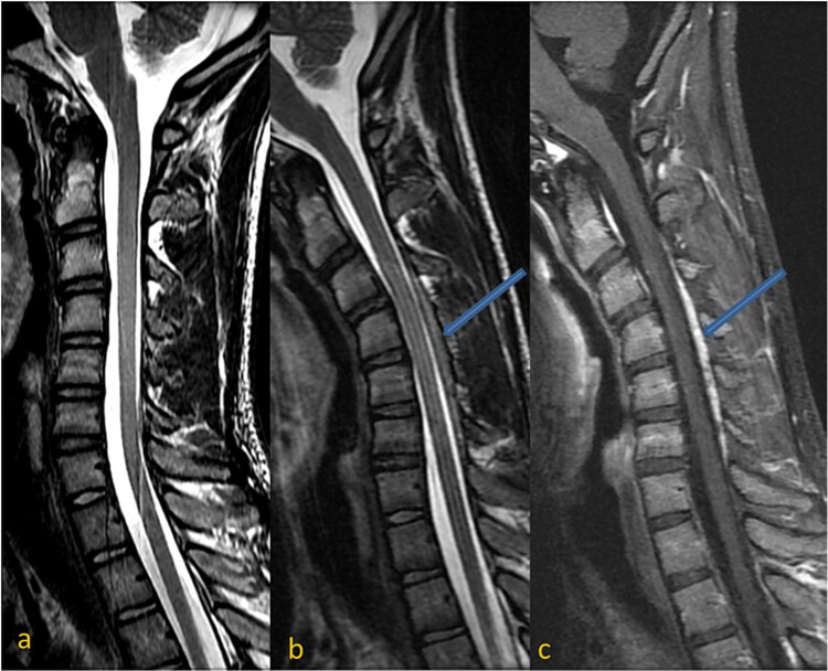 Hirayama disease: a rare cause of cervical myelopathy.