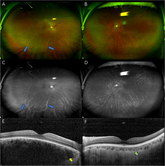 Choroidal hemangioma in Sturge-Weber syndrome elucidated by ultra-widefield swept-source optical coherence tomography angiography.