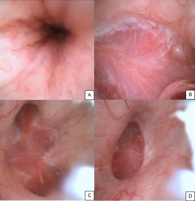 Feasibility and safety of 6.3 Fr vs. 7.5 Fr digital disposable ureteroscopes in retrograde intrarenal surgery: a prospective randomised trial.
