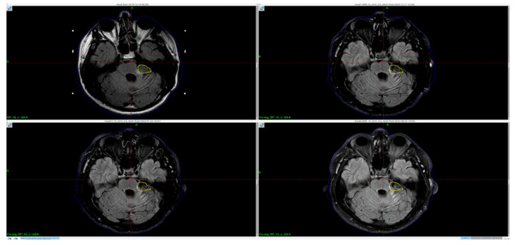 Boomerang Sign in the Splenium of the Corpus Callosum After Vestibullar Schwannoma Treatment: Case Report and Review of the Literature.