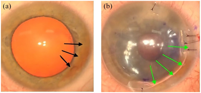 Descemet's membrane endothelial keratoplasty in an eye with iridocorneal endothelial syndrome and rare association of corneal ectasia.
