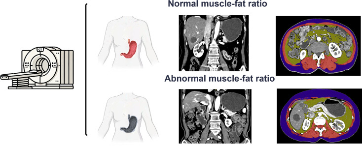 Enhancing risk stratification in diabetic gastric cancer: muscle-fat ratio from photon-counting CT as a predictor of postoperative complications.