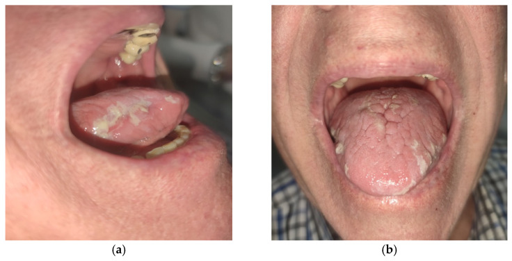 Chronic Hyperplastic Candidiasis-An Adverse Event of Secukinumab in the Oral Cavity: A Case Report and Literature Review.