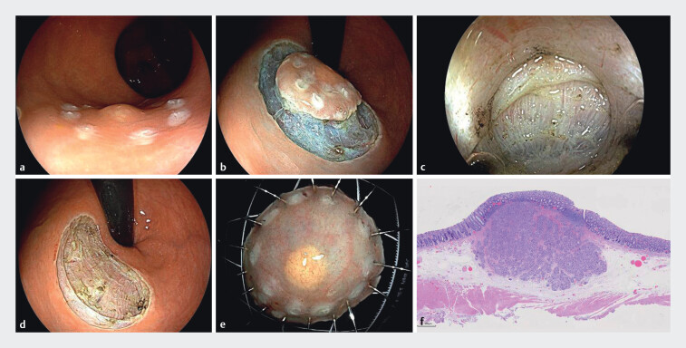 Efficacy of endoscopic intermuscular dissection vs. endoscopic submucosal dissection in treating rectal neuroendocrine tumors < 10 mm.