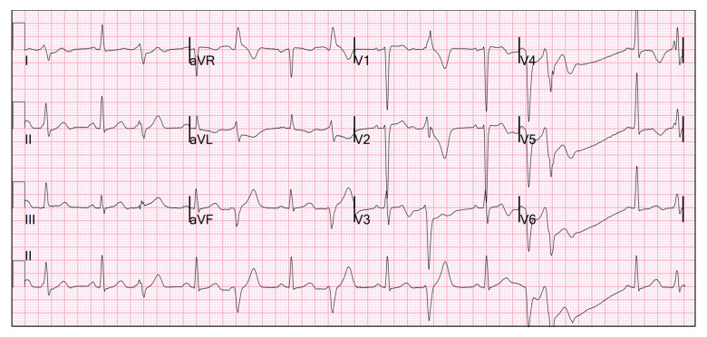 Management of Malignant Arrhythmia in Apical Hypertrophic Cardiomyopathy: A Case Report.