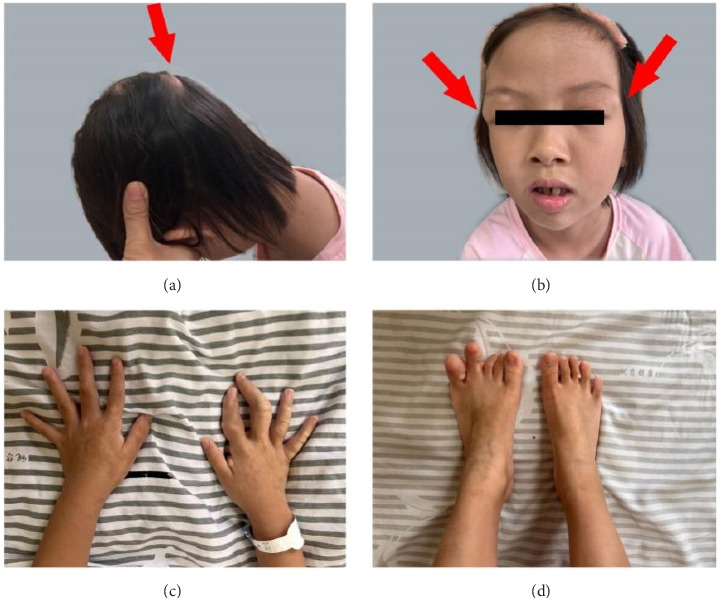 A Case of Proteus Syndrome, Suspected as Maffucci Syndrome in a Chinese Child.