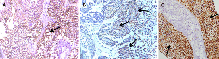 Correction to "Clinicohistopathological implications of phosphoserine 9 glycogen synthase kinase-3β/ β-catenin in urinary bladder cancer patients".