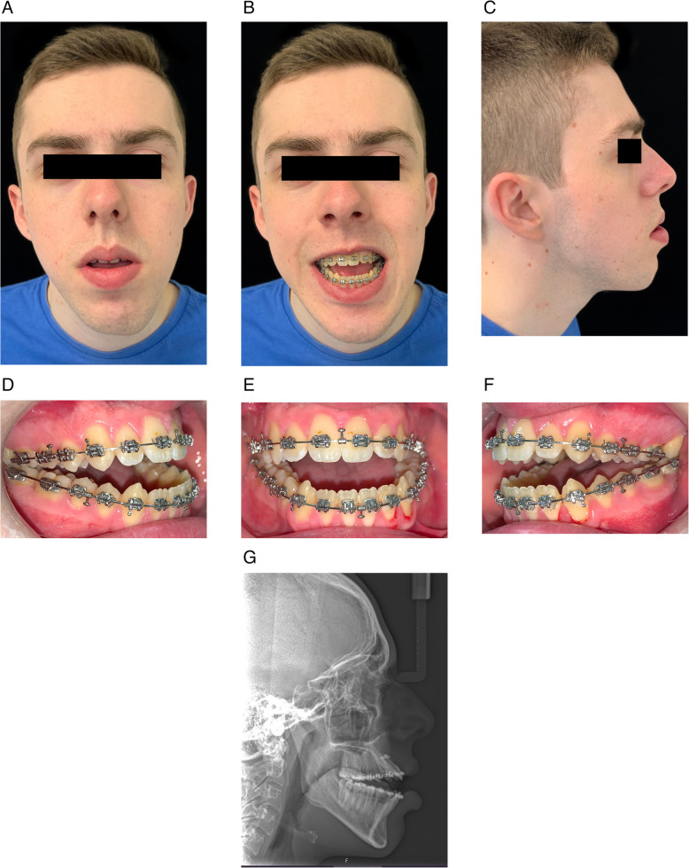 A novel technique to improve postoperative stability of orthognathic surgical anterior open bite correction using temporary anchorage devices: a case report.