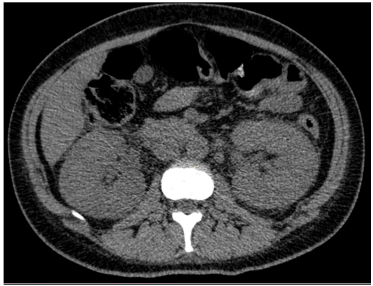 Renal Malacoplakia Following Obstetric Intervention: A Rare Cause of Acute Kidney Injury in a Young Woman.