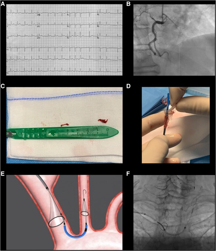 Treatment of impending paradoxical embolism with systemic thrombolysis and cerebral embolic protection: a case report.